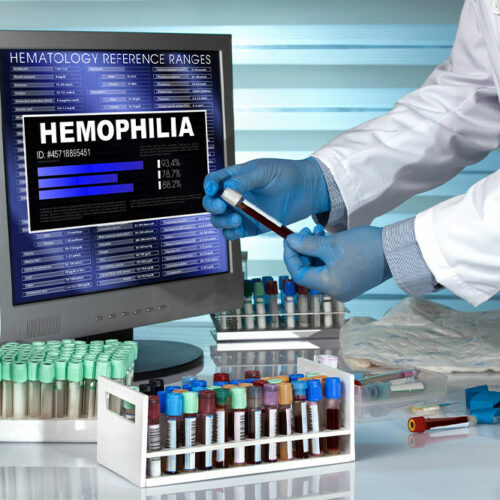 5 ways to live healthy with hemophilia